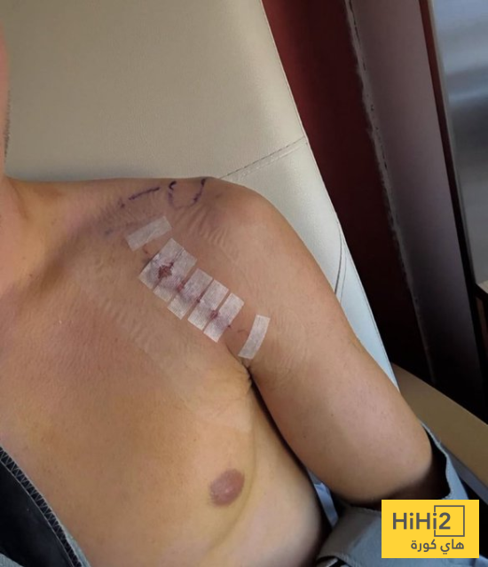 صورة .. كتف هيكتور فورت بعد خضوعه للعملية الجراحية 4 صورة .. كتف هيكتور فورت بعد خضوعه للعملية الجراحية 3